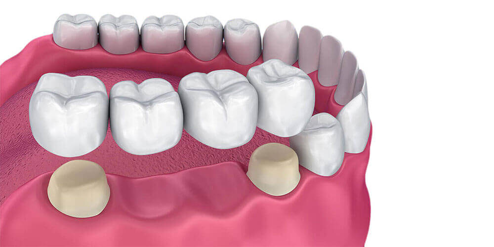 Dental Bridges Kitchener & Cambridge