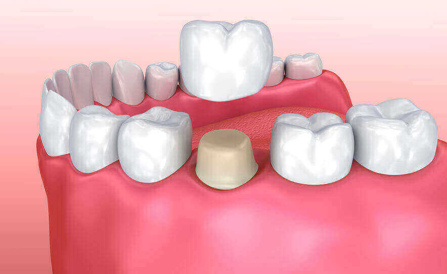 Dental Crowns Kitchener & Cambridge