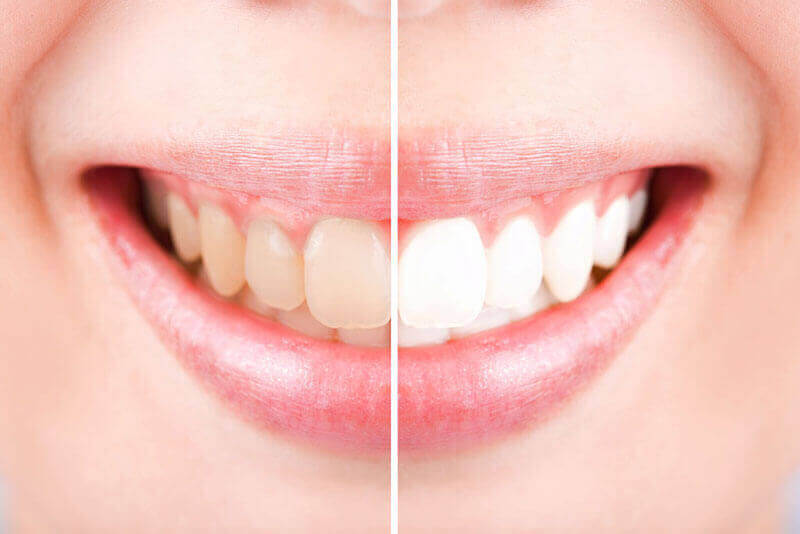 Teeth Whitening Kitchener & Cambridge