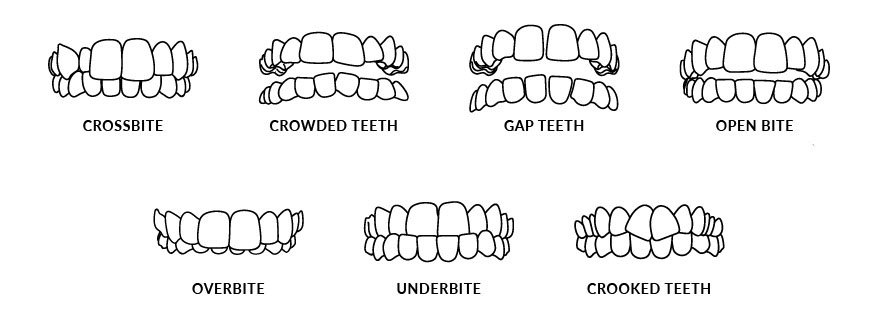 Invisalign, Dentist In Kitchener, ON